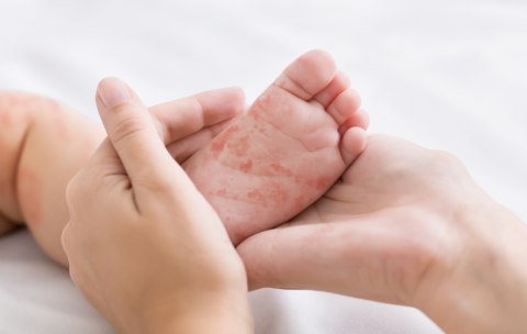 Municípios iniciam vacinação contra o sarampo